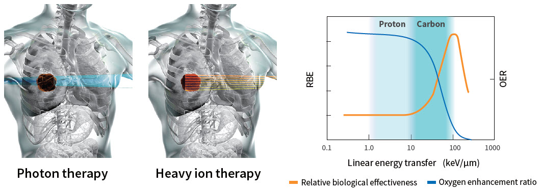 Image of Toshiba Heavy Ion Therapy System targeting tumor in the chest area.